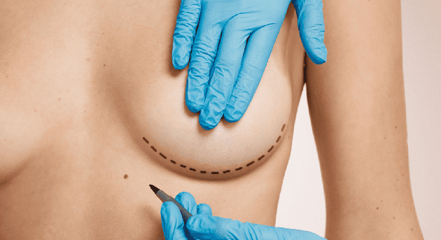 Cirugía de explantación con mamoplastia en Medellín, Colombia